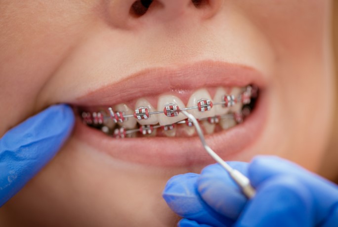тривалість носіння брекетів